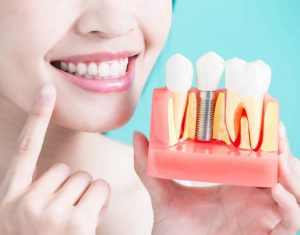 Menos desconforto, mais qualidade de vida: benefícios do implante dentário
